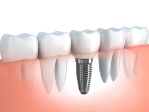 Dental Implants Solihull
