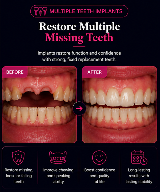 Before and after multiple dental implants in Solihull restoring several missing teeth with fixed, natural-looking replacement teeth.