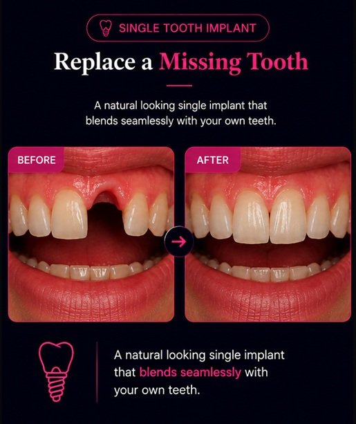 Before and after single tooth dental implant treatment in Solihull showing replacement of a missing front tooth with a natural-looking implant.