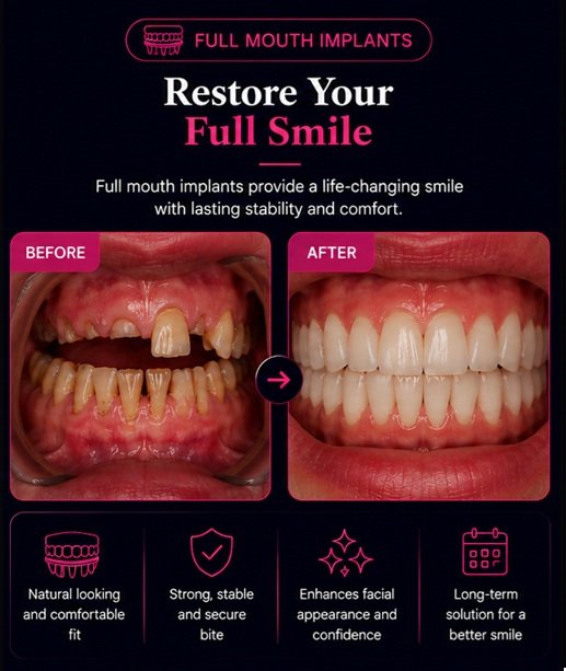 Before and after full mouth dental implants in Solihull showing complete smile restoration with permanent implant-supported teeth.